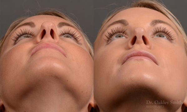 rhinoplasty Nothing demonstrates the skillful craftsmanship that Dr. Oakley Smith accomplishes during his surgeries than a collection of before and after case studies. As one of a hand full of surgeons in North America who limits his practice to only Rhinoplasty surgery, it is obvious that he has mastered his art. There is no question why he is one of the busiest cosmetic nose job surgeons in the country.
