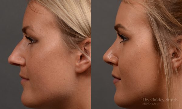 Female nose rhinoplasty to create a more feminine nose