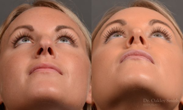 Female nose rhinoplasty to create a more feminine nose