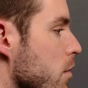 rhinoplasty for straighter nose