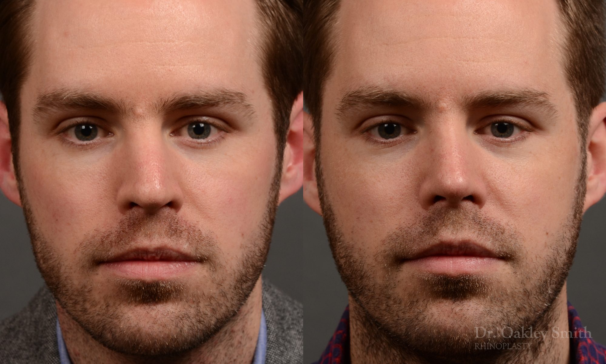 rhinoplasty Nothing demonstrates the skillful craftsmanship that Dr. Oakley Smith accomplishes during his surgeries than a collection of before and after case studies. As one of a hand full of surgeons in North America who limits his practice to only Rhinoplasty surgery, it is obvious that he has mastered his art. There is no question why he is one of the busiest cosmetic nose job surgeons in the country.