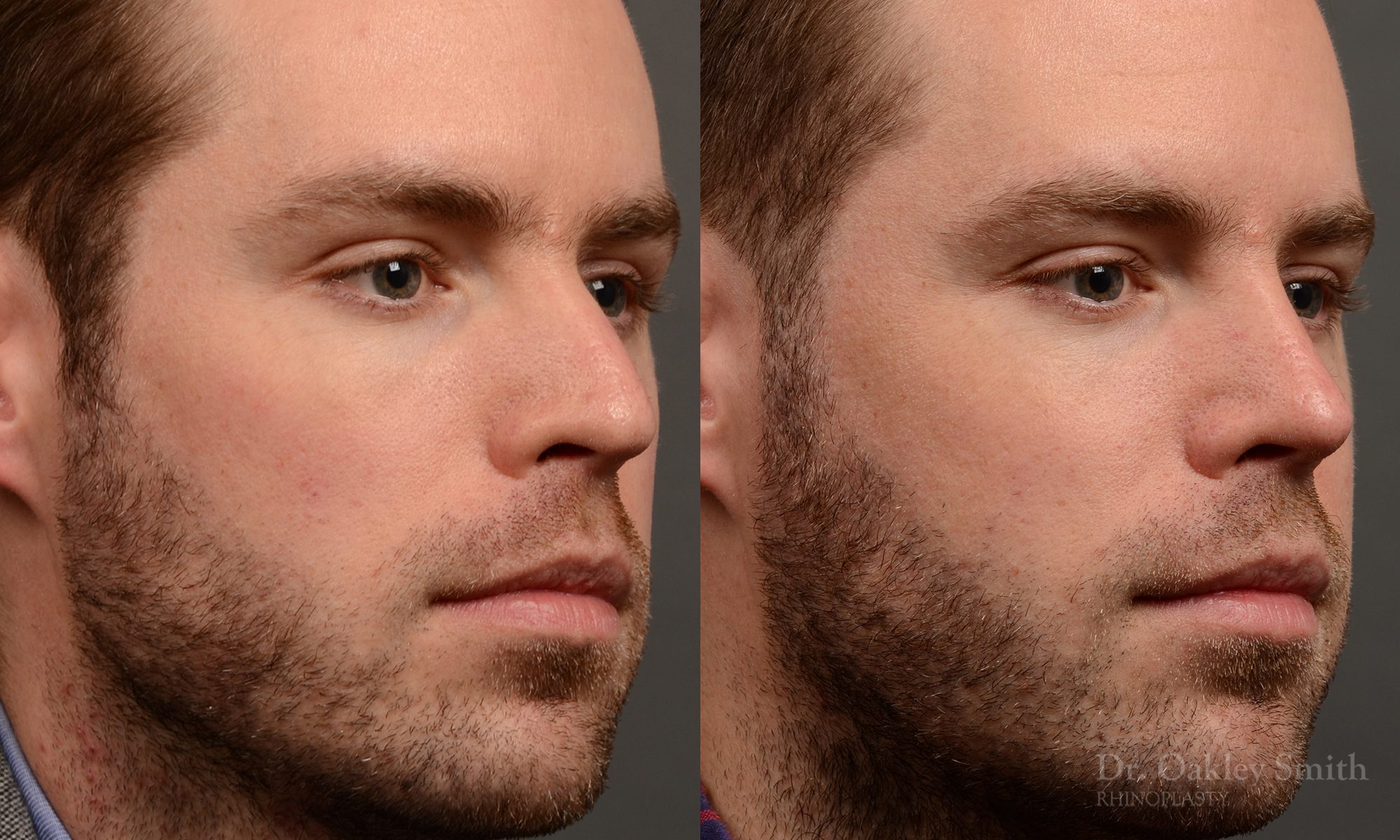 rhinoplasty Nothing demonstrates the skillful craftsmanship that Dr. Oakley Smith accomplishes during his surgeries than a collection of before and after case studies. As one of a hand full of surgeons in North America who limits his practice to only Rhinoplasty surgery, it is obvious that he has mastered his art. There is no question why he is one of the busiest cosmetic nose job surgeons in the country.