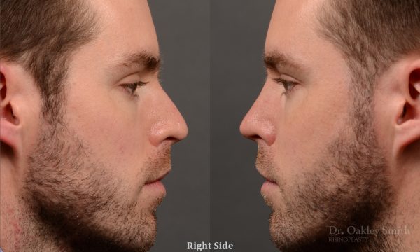 rhinoplasty Nothing demonstrates the skillful craftsmanship that Dr. Oakley Smith accomplishes during his surgeries than a collection of before and after case studies. As one of a hand full of surgeons in North America who limits his practice to only Rhinoplasty surgery, it is obvious that he has mastered his art. There is no question why he is one of the busiest cosmetic nose job surgeons in the country.