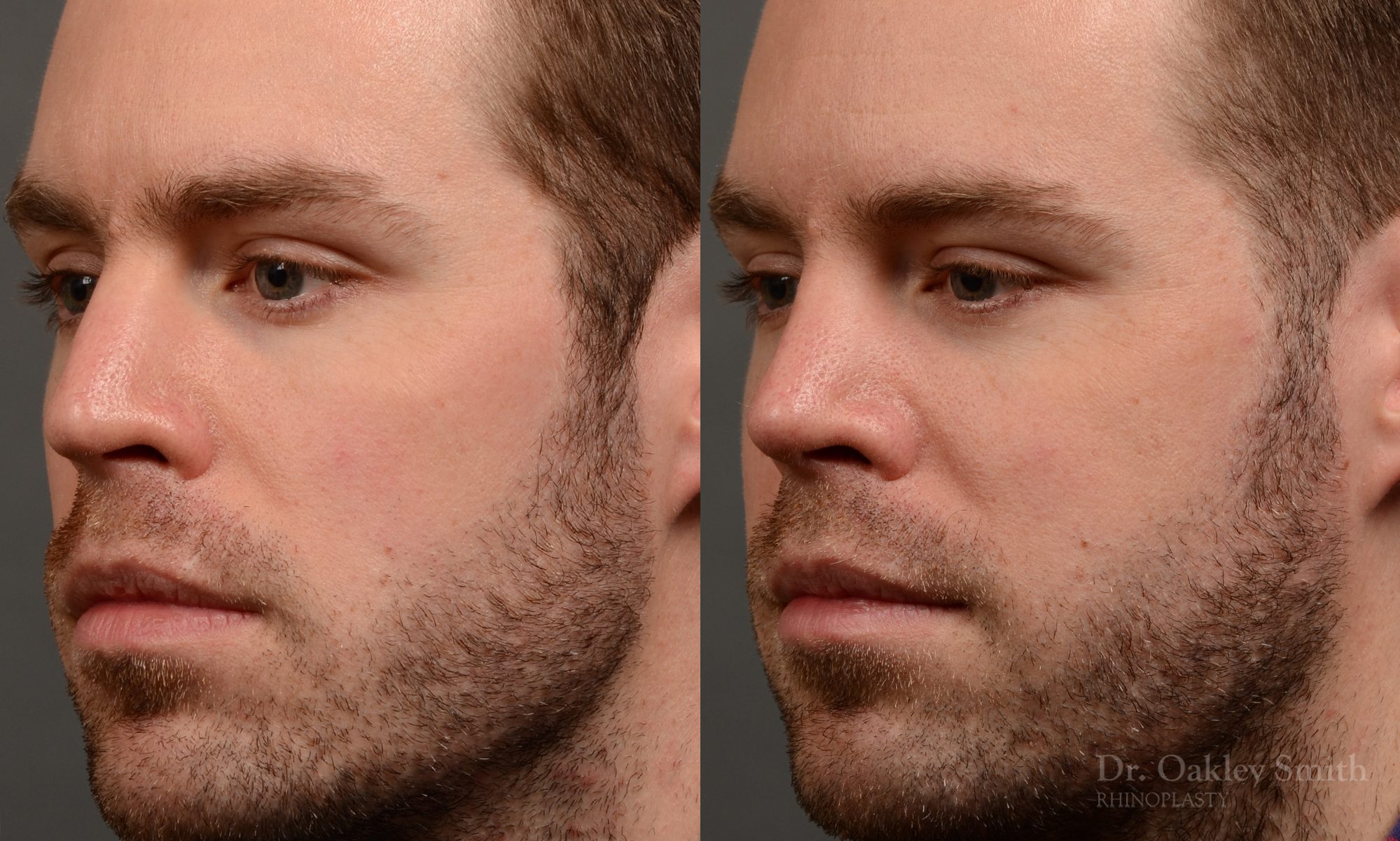 rhinoplasty Nothing demonstrates the skillful craftsmanship that Dr. Oakley Smith accomplishes during his surgeries than a collection of before and after case studies. As one of a hand full of surgeons in North America who limits his practice to only Rhinoplasty surgery, it is obvious that he has mastered his art. There is no question why he is one of the busiest cosmetic nose job surgeons in the country.