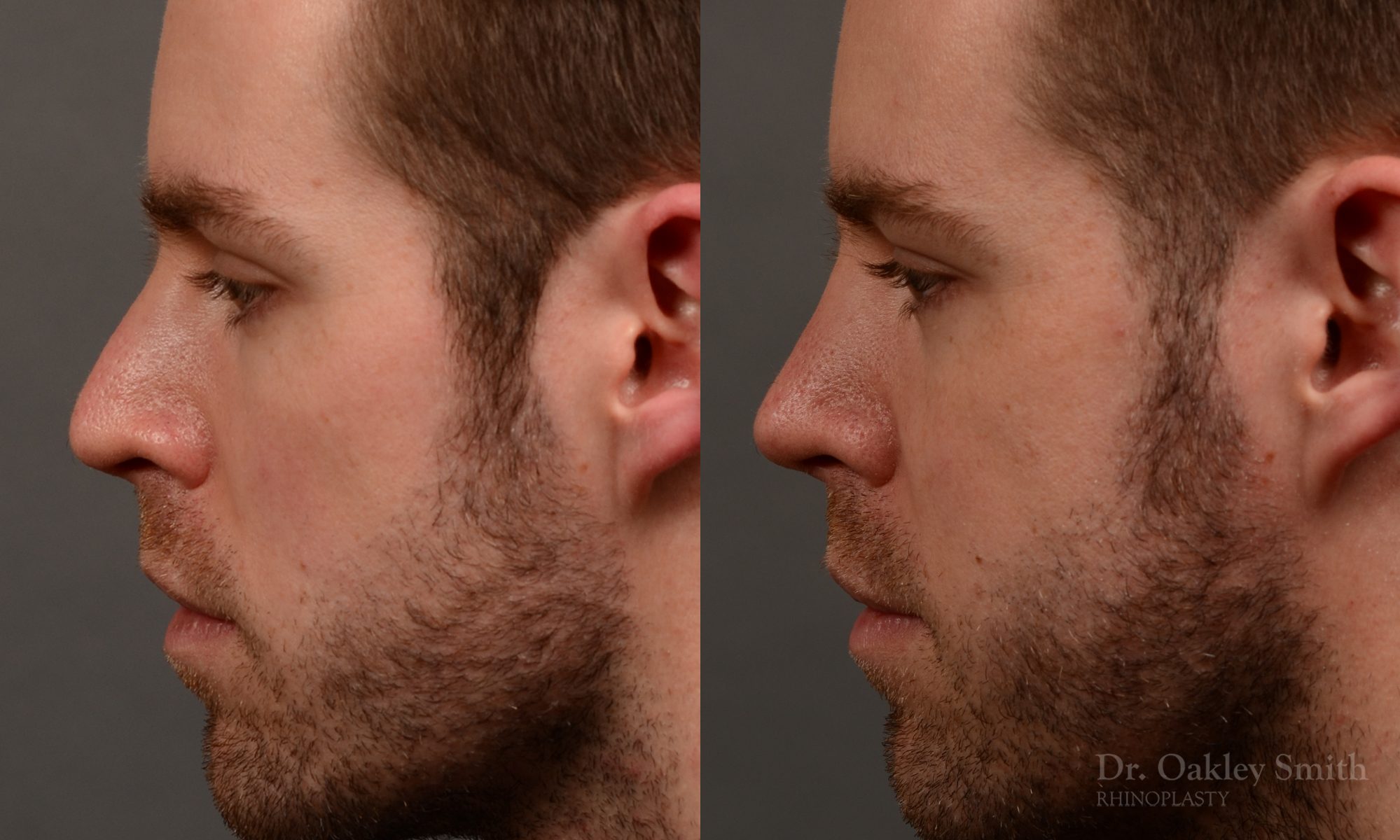 rhinoplasty Nothing demonstrates the skillful craftsmanship that Dr. Oakley Smith accomplishes during his surgeries than a collection of before and after case studies. As one of a hand full of surgeons in North America who limits his practice to only Rhinoplasty surgery, it is obvious that he has mastered his art. There is no question why he is one of the busiest cosmetic nose job surgeons in the country.