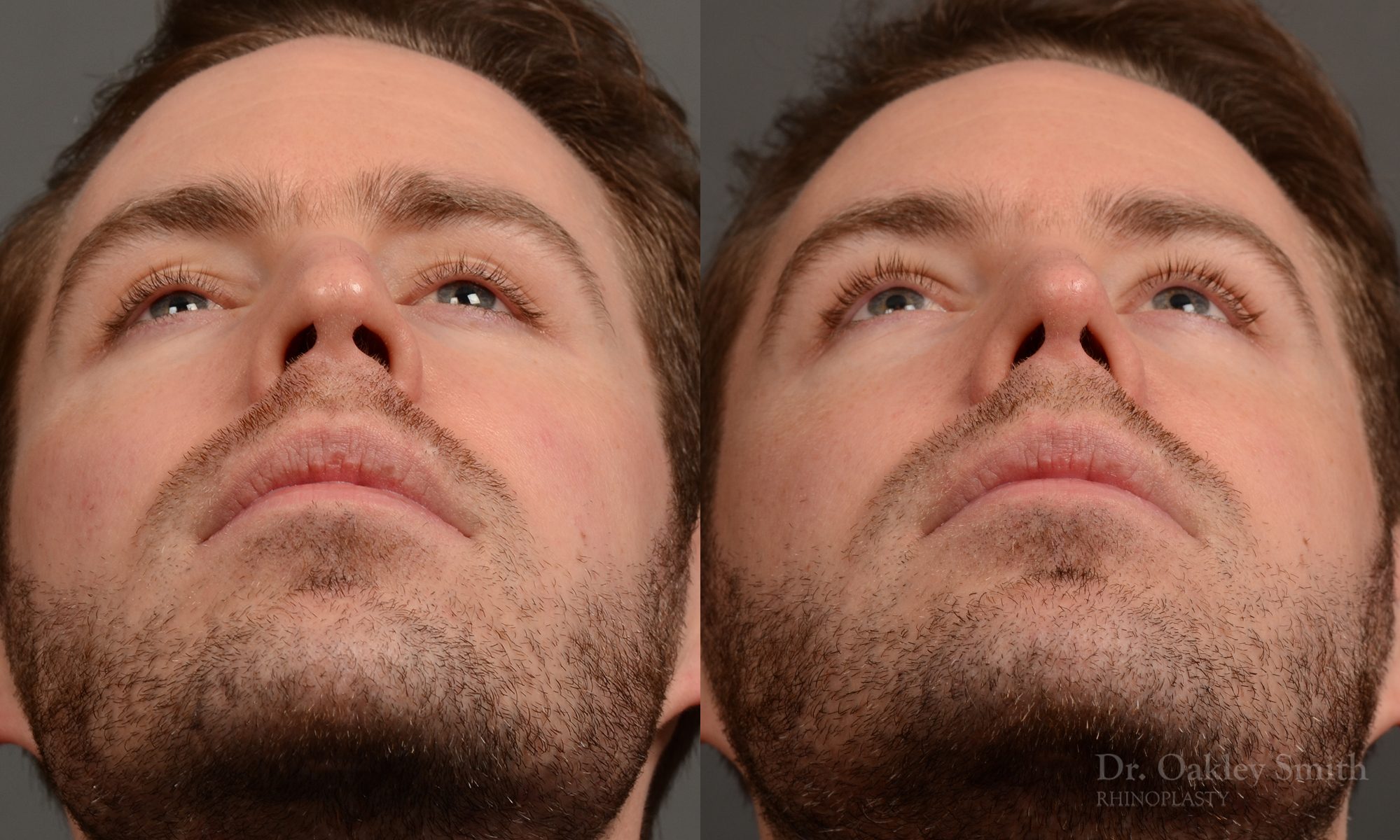 rhinoplasty Nothing demonstrates the skillful craftsmanship that Dr. Oakley Smith accomplishes during his surgeries than a collection of before and after case studies. As one of a hand full of surgeons in North America who limits his practice to only Rhinoplasty surgery, it is obvious that he has mastered his art. There is no question why he is one of the busiest cosmetic nose job surgeons in the country.
