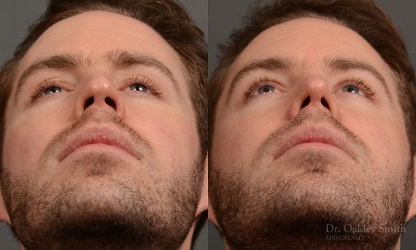 rhinoplasty Nothing demonstrates the skillful craftsmanship that Dr. Oakley Smith accomplishes during his surgeries than a collection of before and after case studies. As one of a hand full of surgeons in North America who limits his practice to only Rhinoplasty surgery, it is obvious that he has mastered his art. There is no question why he is one of the busiest cosmetic nose job surgeons in the country.