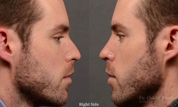 rhinoplasty for straighter nose