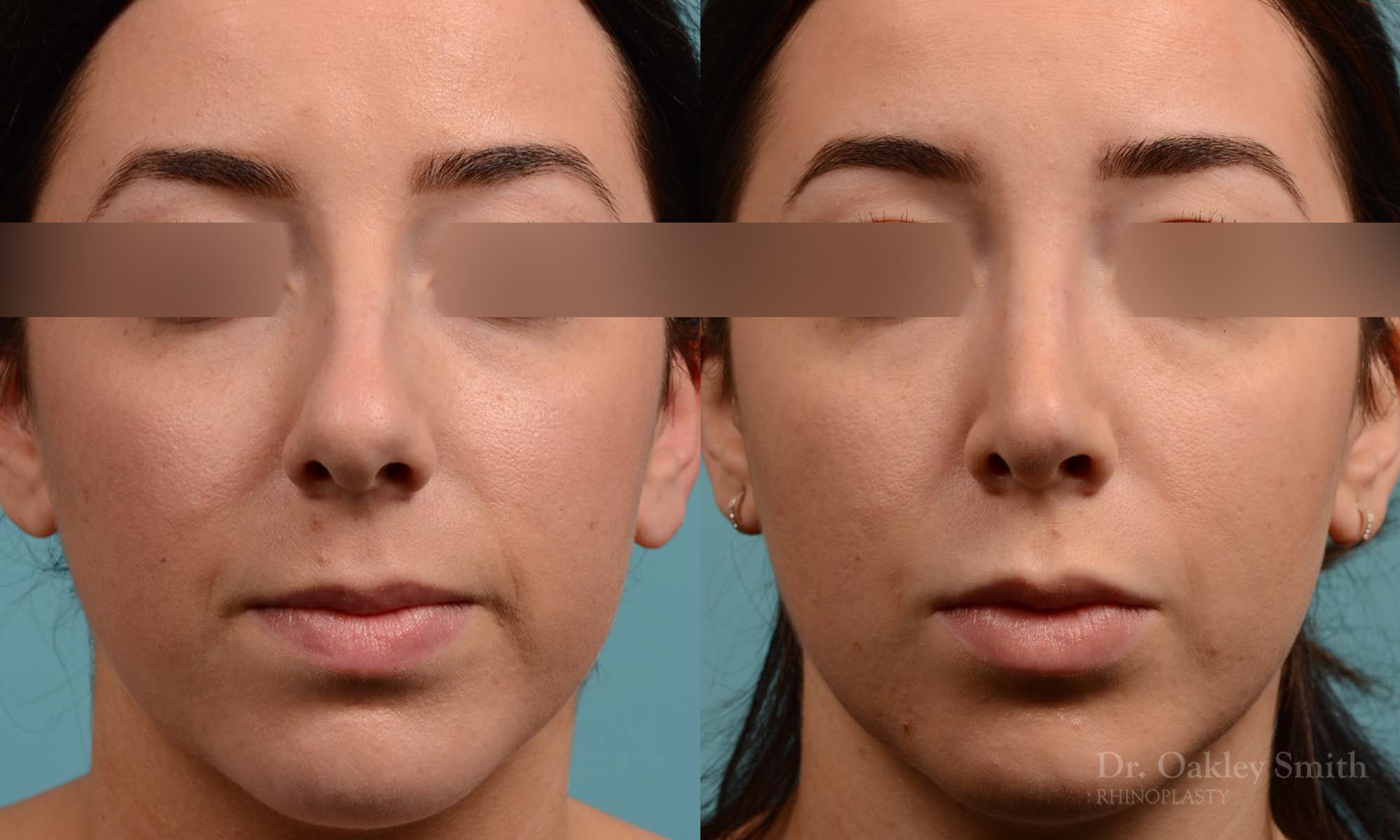 This woman had rhinoplasty to reduce the overall size of her nose. the result is more feminine