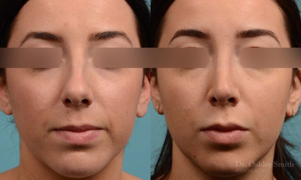 This woman had rhinoplasty to reduce the overall size of her nose. the result is more feminine