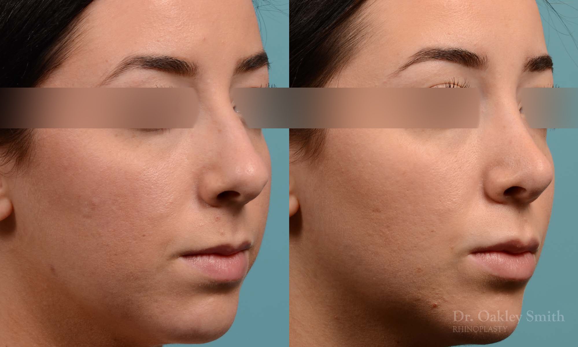 This woman had rhinoplasty to reduce the overall size of her nose. the result is more feminine