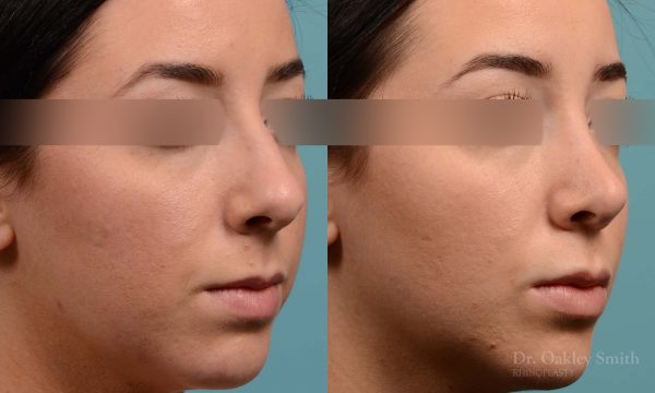 This woman had rhinoplasty to reduce the overall size of her nose. the result is more feminine