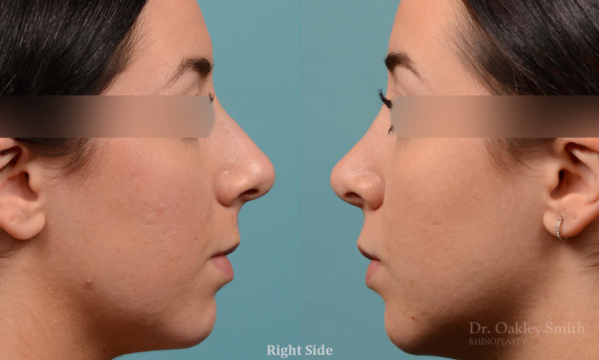 This woman had rhinoplasty to reduce the overall size of her nose. the result is more feminine