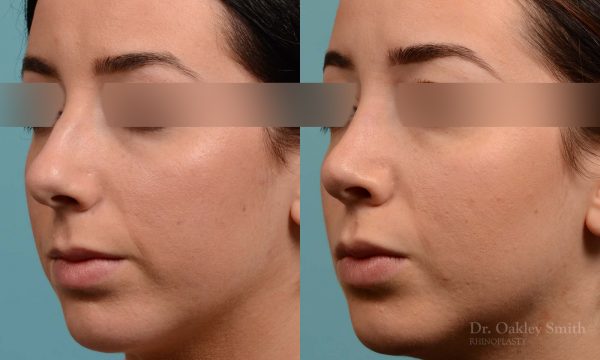 This woman had rhinoplasty to reduce the overall size of her nose. the result is more feminine