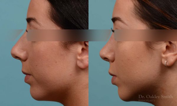 This woman had rhinoplasty to reduce the overall size of her nose. the result is more feminine