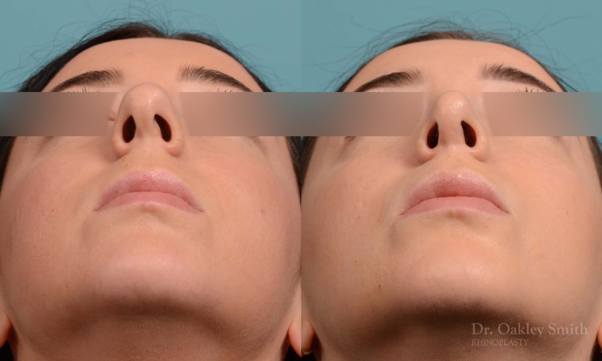 This woman had rhinoplasty to reduce the overall size of her nose. the result is more feminine