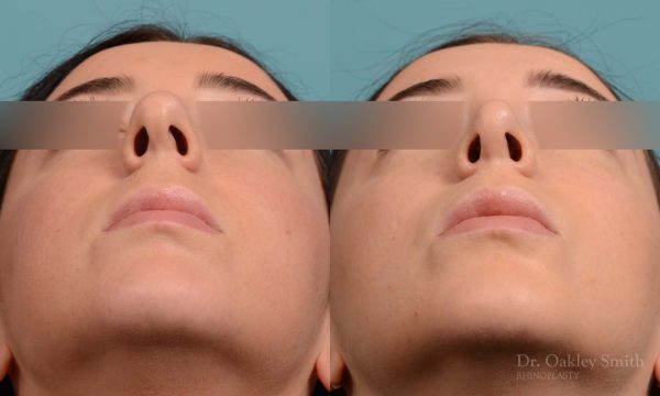 This woman had rhinoplasty to reduce the overall size of her nose. the result is more feminine