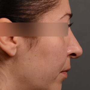 Female rhinoplasty for overall smaller nose