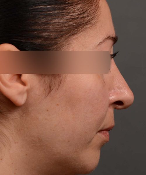 Female rhinoplasty for overall smaller nose