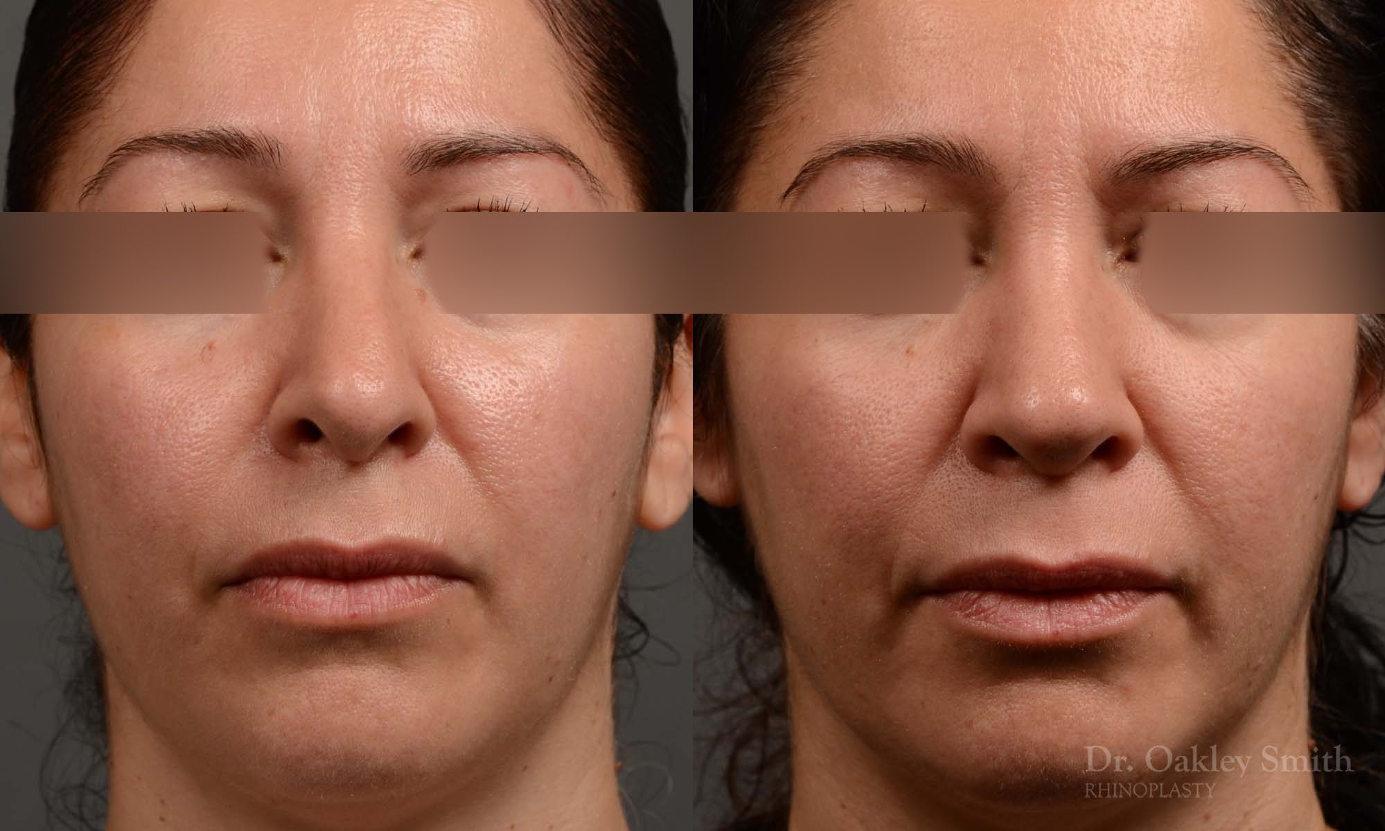 rhinoplasty Nothing demonstrates the skillful craftsmanship that Dr. Oakley Smith accomplishes during his surgeries than a collection of before and after case studies. As one of a hand full of surgeons in North America who limits his practice to only Rhinoplasty surgery, it is obvious that he has mastered his art. There is no question why he is one of the busiest cosmetic nose job surgeons in the country.