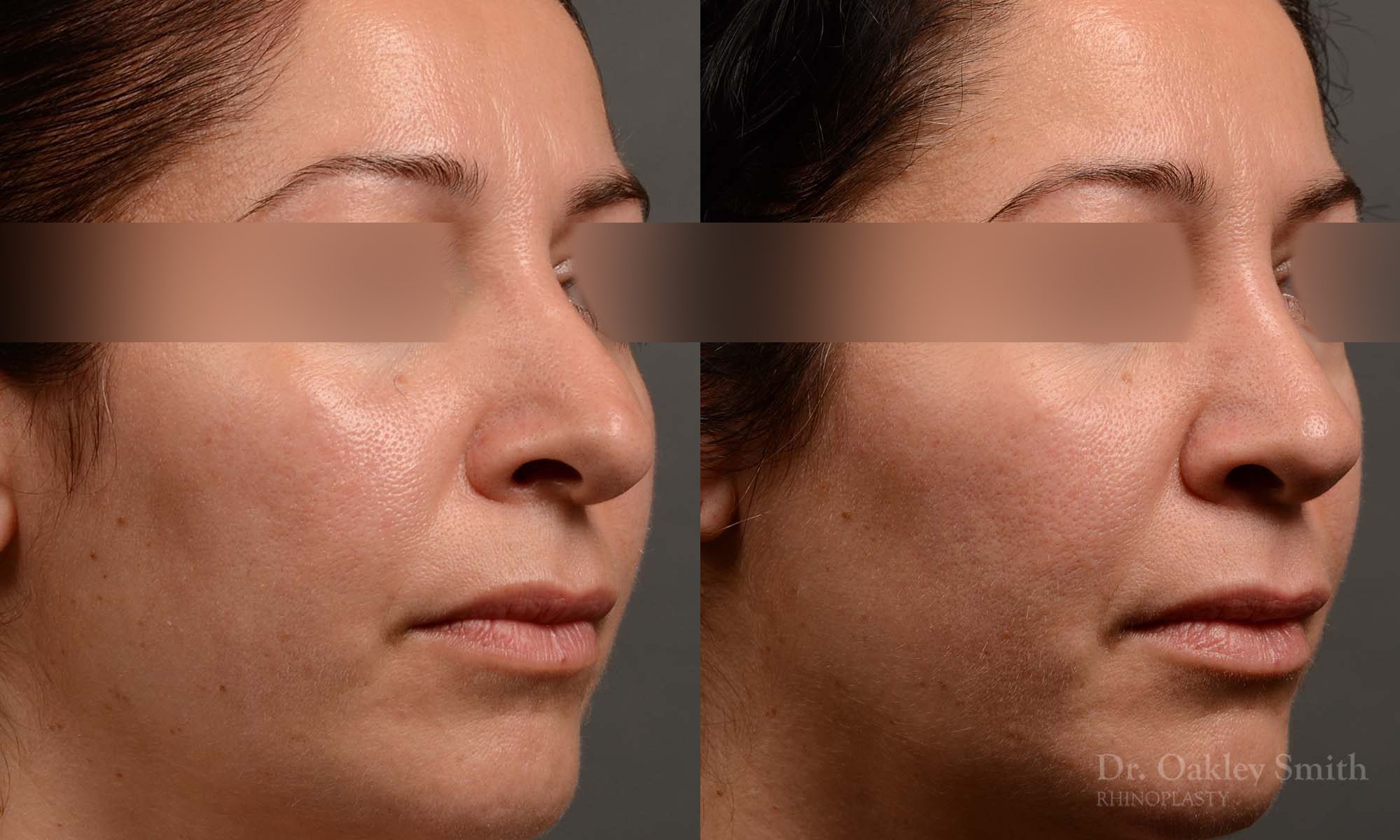 rhinoplasty Nothing demonstrates the skillful craftsmanship that Dr. Oakley Smith accomplishes during his surgeries than a collection of before and after case studies. As one of a hand full of surgeons in North America who limits his practice to only Rhinoplasty surgery, it is obvious that he has mastered his art. There is no question why he is one of the busiest cosmetic nose job surgeons in the country.