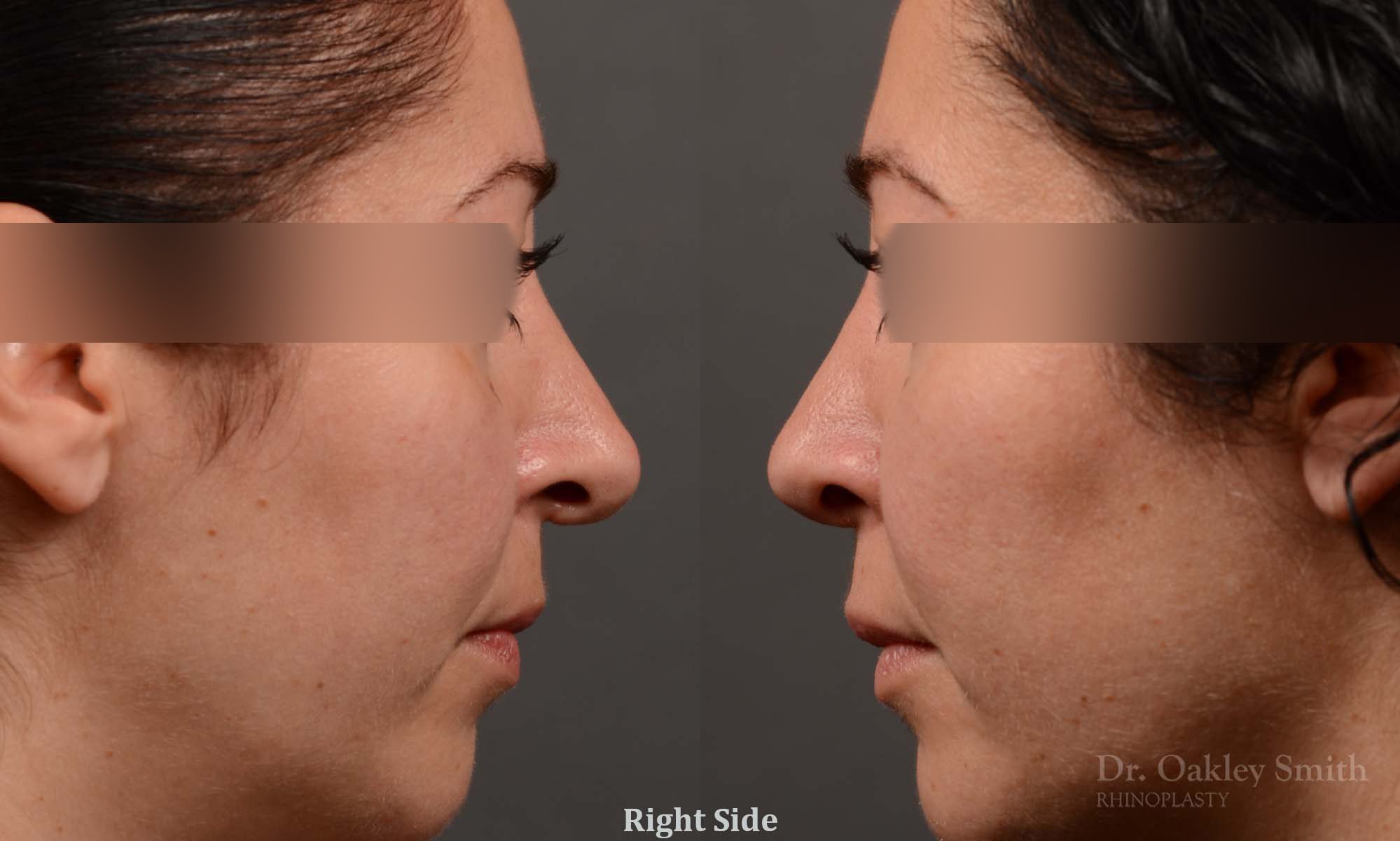 rhinoplasty Nothing demonstrates the skillful craftsmanship that Dr. Oakley Smith accomplishes during his surgeries than a collection of before and after case studies. As one of a hand full of surgeons in North America who limits his practice to only Rhinoplasty surgery, it is obvious that he has mastered his art. There is no question why he is one of the busiest cosmetic nose job surgeons in the country.