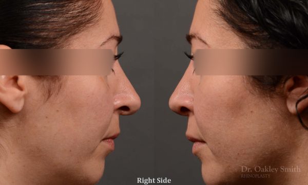 rhinoplasty Nothing demonstrates the skillful craftsmanship that Dr. Oakley Smith accomplishes during his surgeries than a collection of before and after case studies. As one of a hand full of surgeons in North America who limits his practice to only Rhinoplasty surgery, it is obvious that he has mastered his art. There is no question why he is one of the busiest cosmetic nose job surgeons in the country.