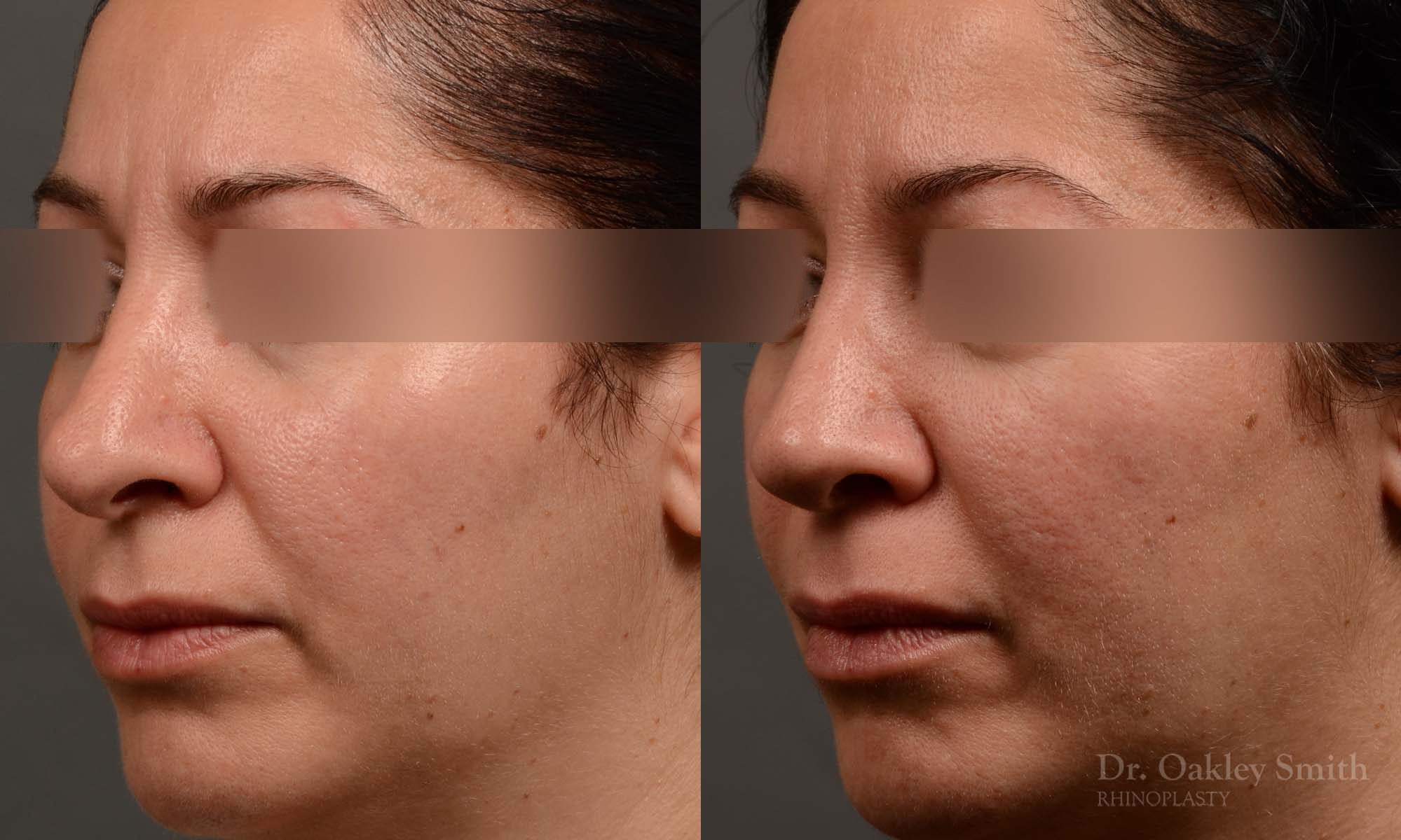 rhinoplasty Nothing demonstrates the skillful craftsmanship that Dr. Oakley Smith accomplishes during his surgeries than a collection of before and after case studies. As one of a hand full of surgeons in North America who limits his practice to only Rhinoplasty surgery, it is obvious that he has mastered his art. There is no question why he is one of the busiest cosmetic nose job surgeons in the country.