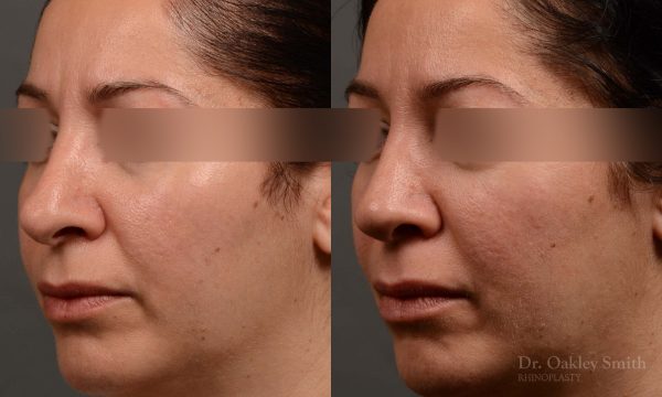 rhinoplasty Nothing demonstrates the skillful craftsmanship that Dr. Oakley Smith accomplishes during his surgeries than a collection of before and after case studies. As one of a hand full of surgeons in North America who limits his practice to only Rhinoplasty surgery, it is obvious that he has mastered his art. There is no question why he is one of the busiest cosmetic nose job surgeons in the country.