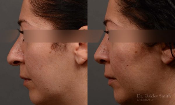 rhinoplasty Nothing demonstrates the skillful craftsmanship that Dr. Oakley Smith accomplishes during his surgeries than a collection of before and after case studies. As one of a hand full of surgeons in North America who limits his practice to only Rhinoplasty surgery, it is obvious that he has mastered his art. There is no question why he is one of the busiest cosmetic nose job surgeons in the country.