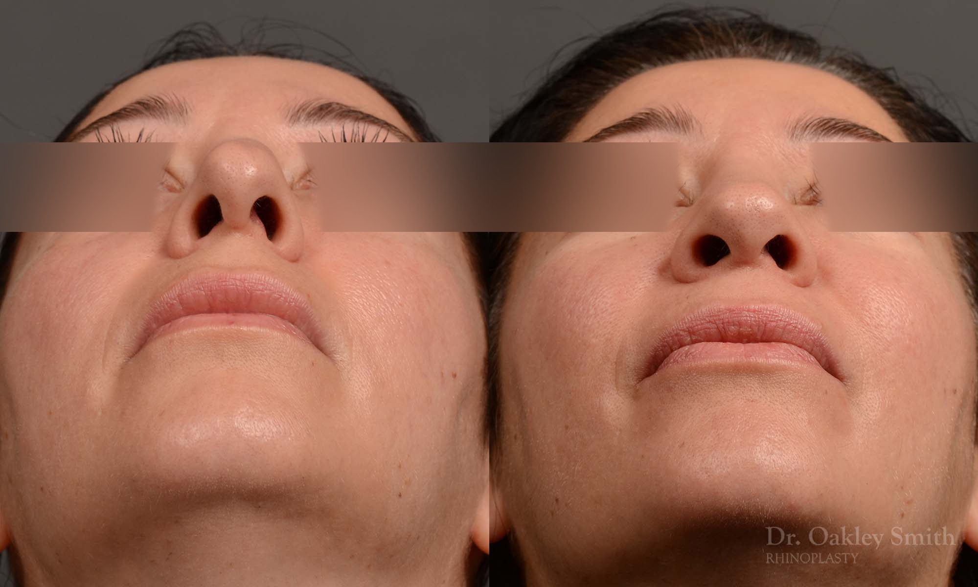 rhinoplasty Nothing demonstrates the skillful craftsmanship that Dr. Oakley Smith accomplishes during his surgeries than a collection of before and after case studies. As one of a hand full of surgeons in North America who limits his practice to only Rhinoplasty surgery, it is obvious that he has mastered his art. There is no question why he is one of the busiest cosmetic nose job surgeons in the country.