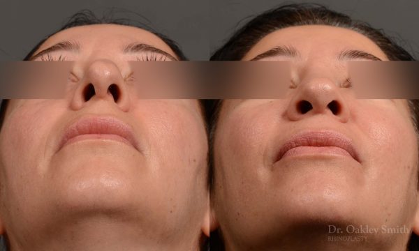 rhinoplasty Nothing demonstrates the skillful craftsmanship that Dr. Oakley Smith accomplishes during his surgeries than a collection of before and after case studies. As one of a hand full of surgeons in North America who limits his practice to only Rhinoplasty surgery, it is obvious that he has mastered his art. There is no question why he is one of the busiest cosmetic nose job surgeons in the country.