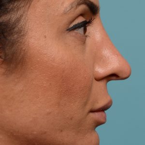 Female rhinoplasty for overall smaller nose