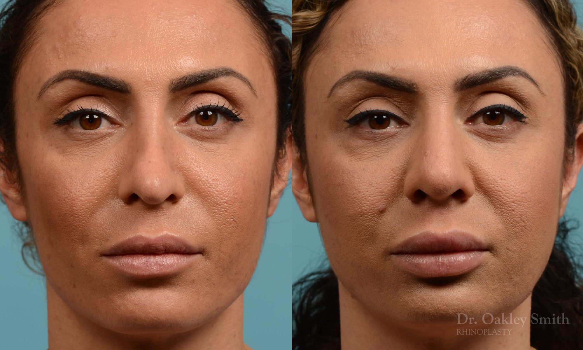 Female rhinoplasty for overall smaller nose