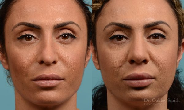 Female rhinoplasty for overall smaller nose