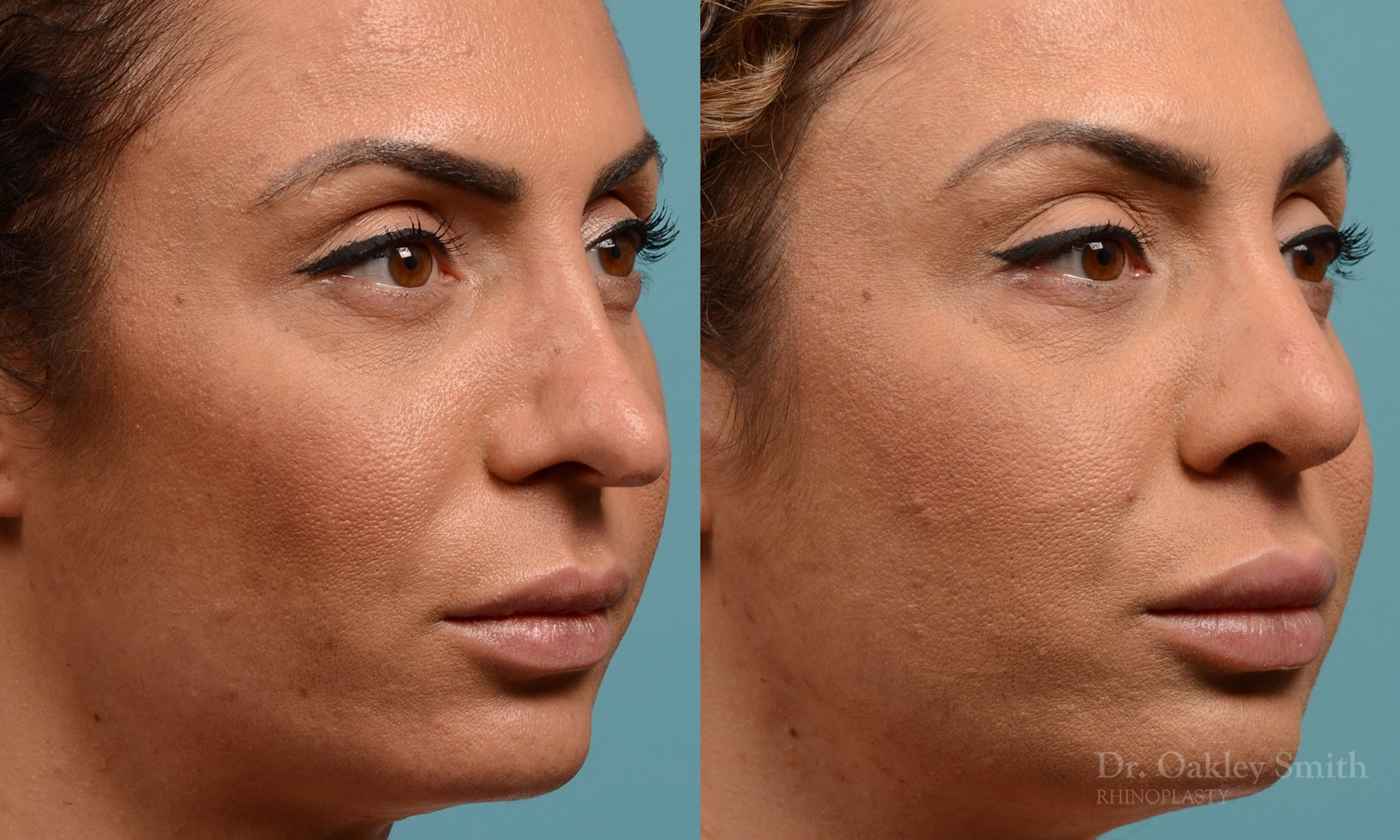 Female rhinoplasty for overall smaller nose