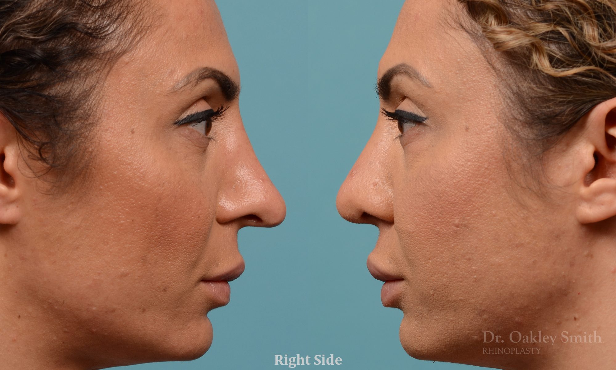 Female rhinoplasty for overall smaller nose