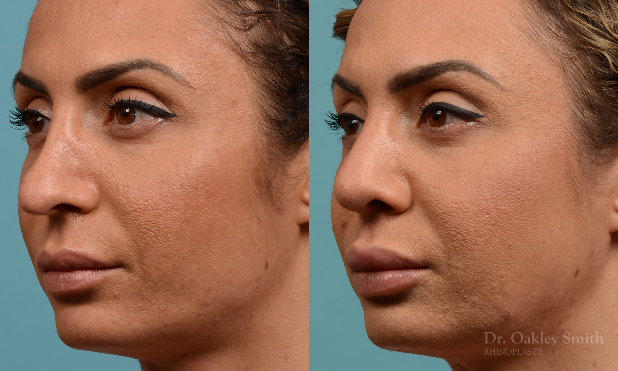 Female rhinoplasty for overall smaller nose