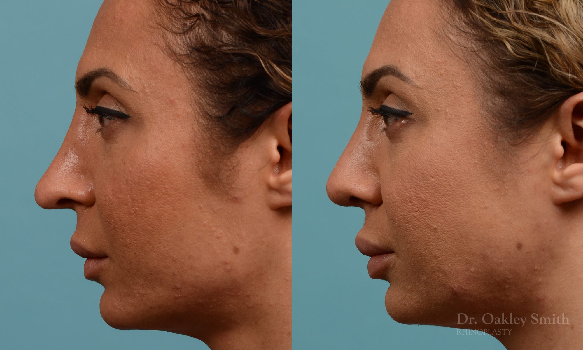 Female rhinoplasty for overall smaller nose