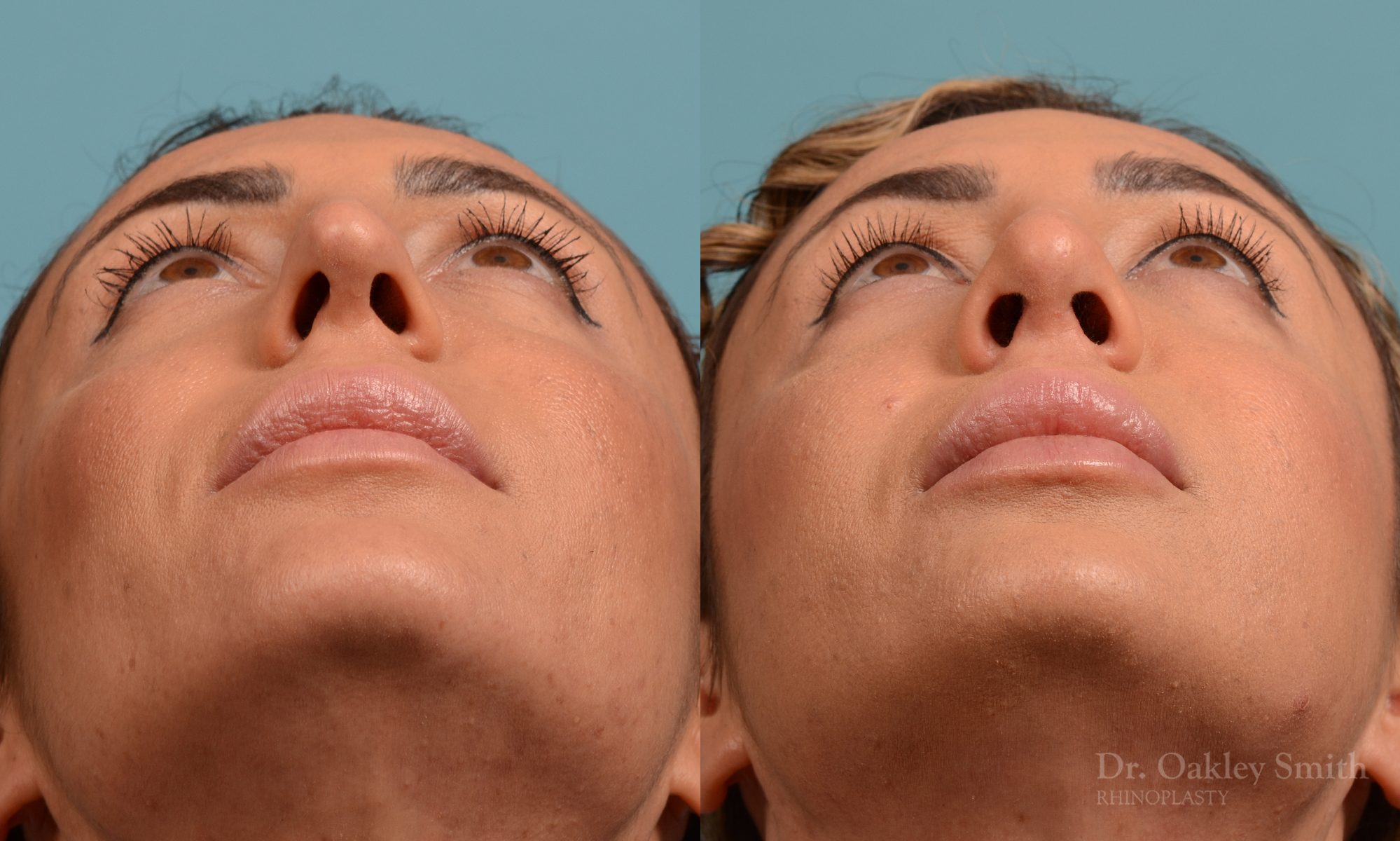 Female rhinoplasty for overall smaller nose