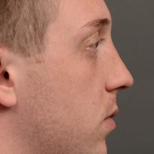 Male rhinoplasty to straigthen nose
