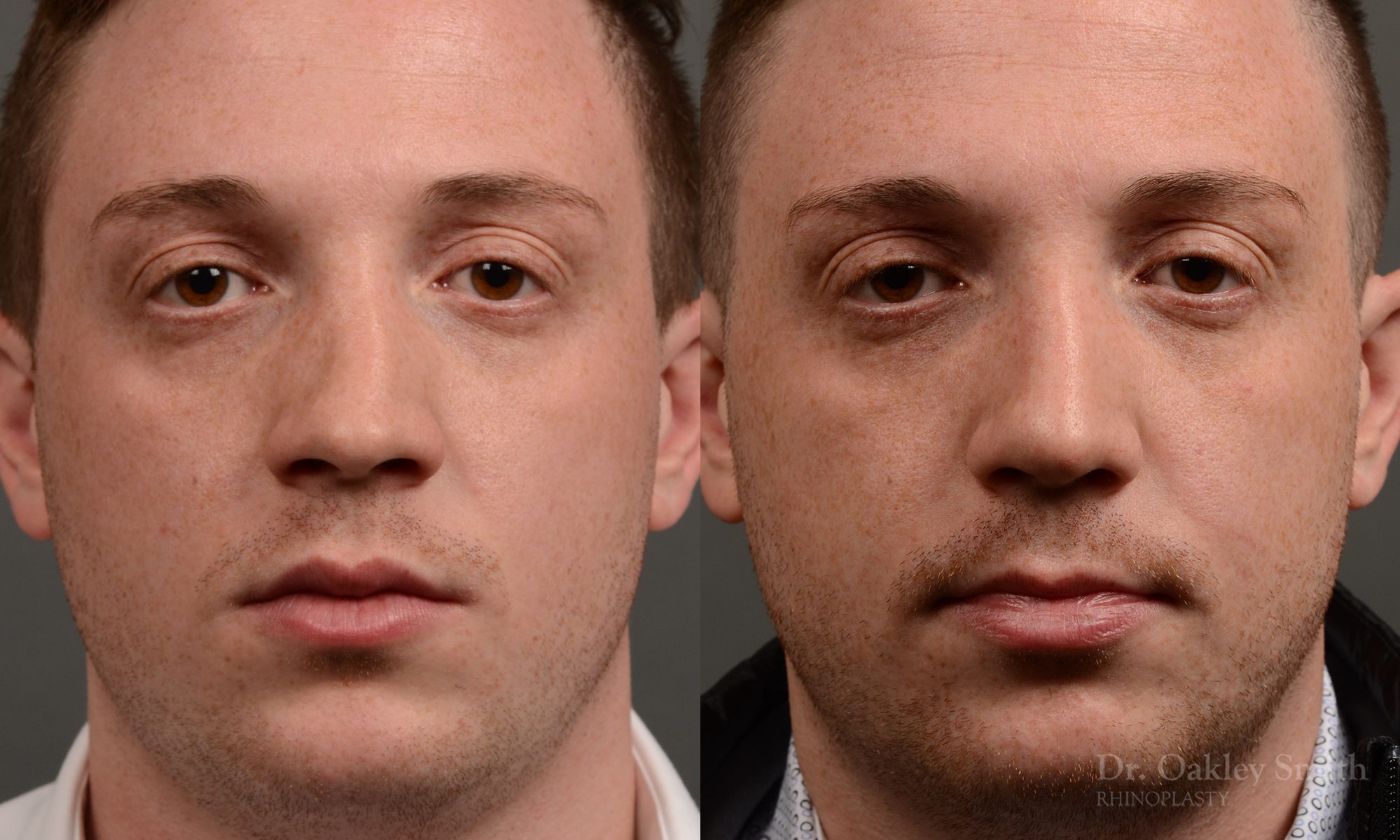 rhinoplasty Nothing demonstrates the skillful craftsmanship that Dr. Oakley Smith accomplishes during his surgeries than a collection of before and after case studies. As one of a hand full of surgeons in North America who limits his practice to only Rhinoplasty surgery, it is obvious that he has mastered his art. There is no question why he is one of the busiest cosmetic nose job surgeons in the country.