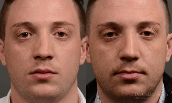rhinoplasty Nothing demonstrates the skillful craftsmanship that Dr. Oakley Smith accomplishes during his surgeries than a collection of before and after case studies. As one of a hand full of surgeons in North America who limits his practice to only Rhinoplasty surgery, it is obvious that he has mastered his art. There is no question why he is one of the busiest cosmetic nose job surgeons in the country.