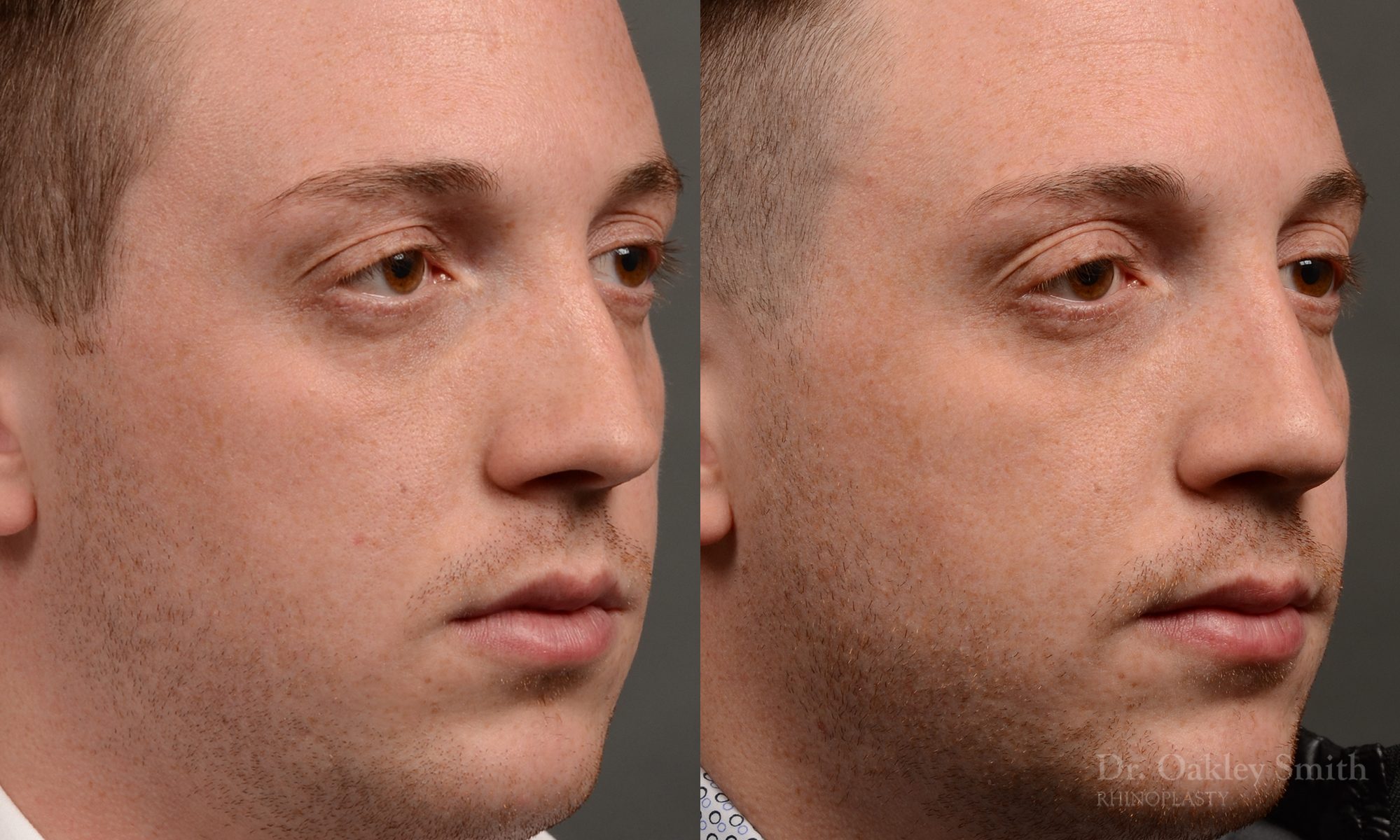 rhinoplasty Nothing demonstrates the skillful craftsmanship that Dr. Oakley Smith accomplishes during his surgeries than a collection of before and after case studies. As one of a hand full of surgeons in North America who limits his practice to only Rhinoplasty surgery, it is obvious that he has mastered his art. There is no question why he is one of the busiest cosmetic nose job surgeons in the country.
