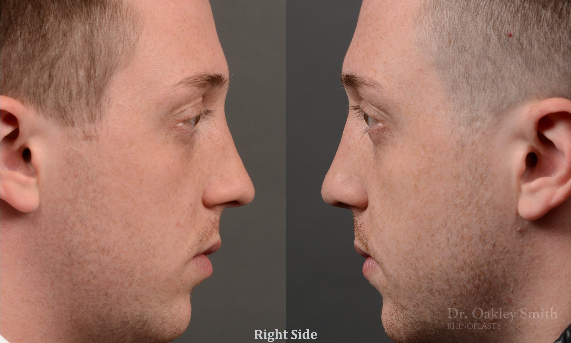 rhinoplasty Nothing demonstrates the skillful craftsmanship that Dr. Oakley Smith accomplishes during his surgeries than a collection of before and after case studies. As one of a hand full of surgeons in North America who limits his practice to only Rhinoplasty surgery, it is obvious that he has mastered his art. There is no question why he is one of the busiest cosmetic nose job surgeons in the country.