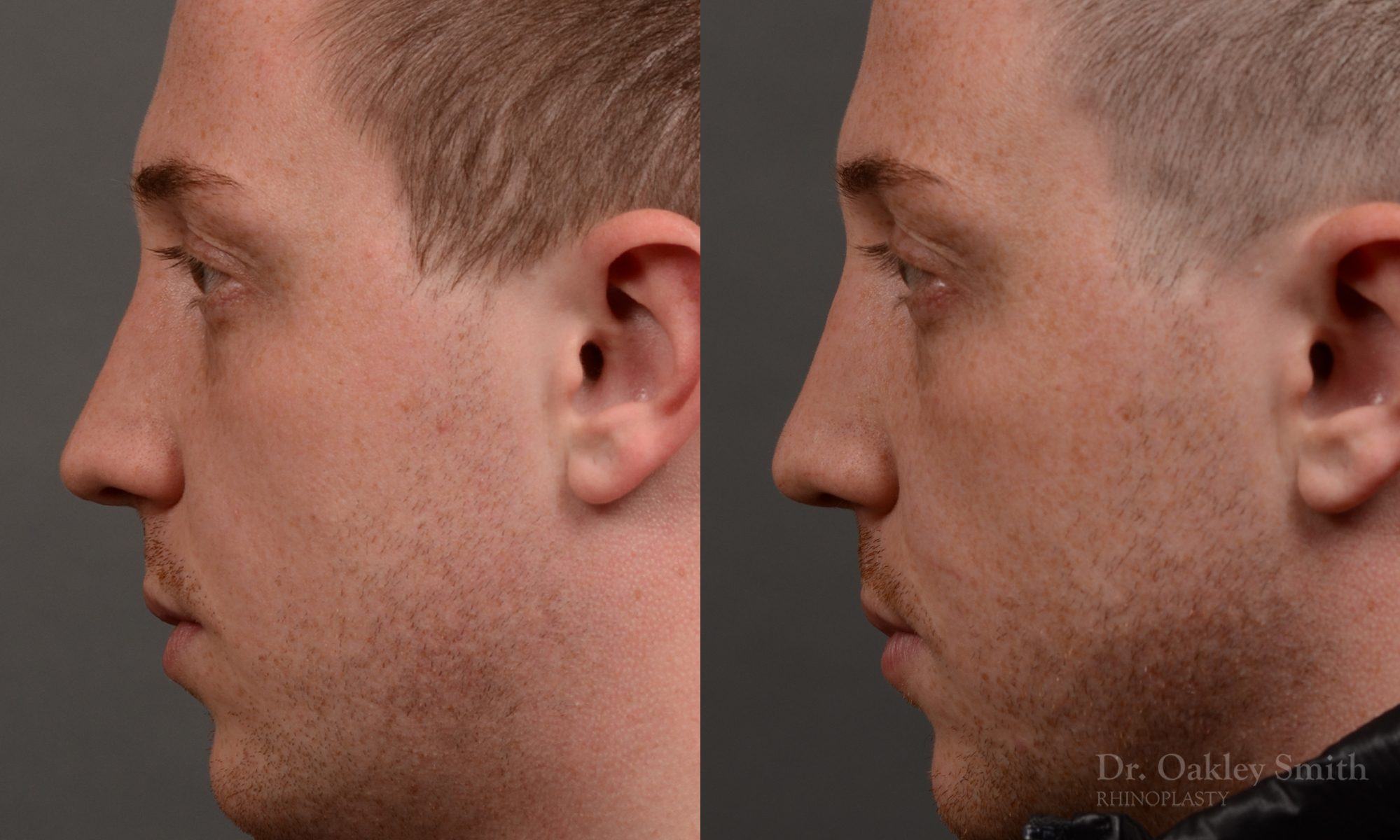 rhinoplasty Nothing demonstrates the skillful craftsmanship that Dr. Oakley Smith accomplishes during his surgeries than a collection of before and after case studies. As one of a hand full of surgeons in North America who limits his practice to only Rhinoplasty surgery, it is obvious that he has mastered his art. There is no question why he is one of the busiest cosmetic nose job surgeons in the country.