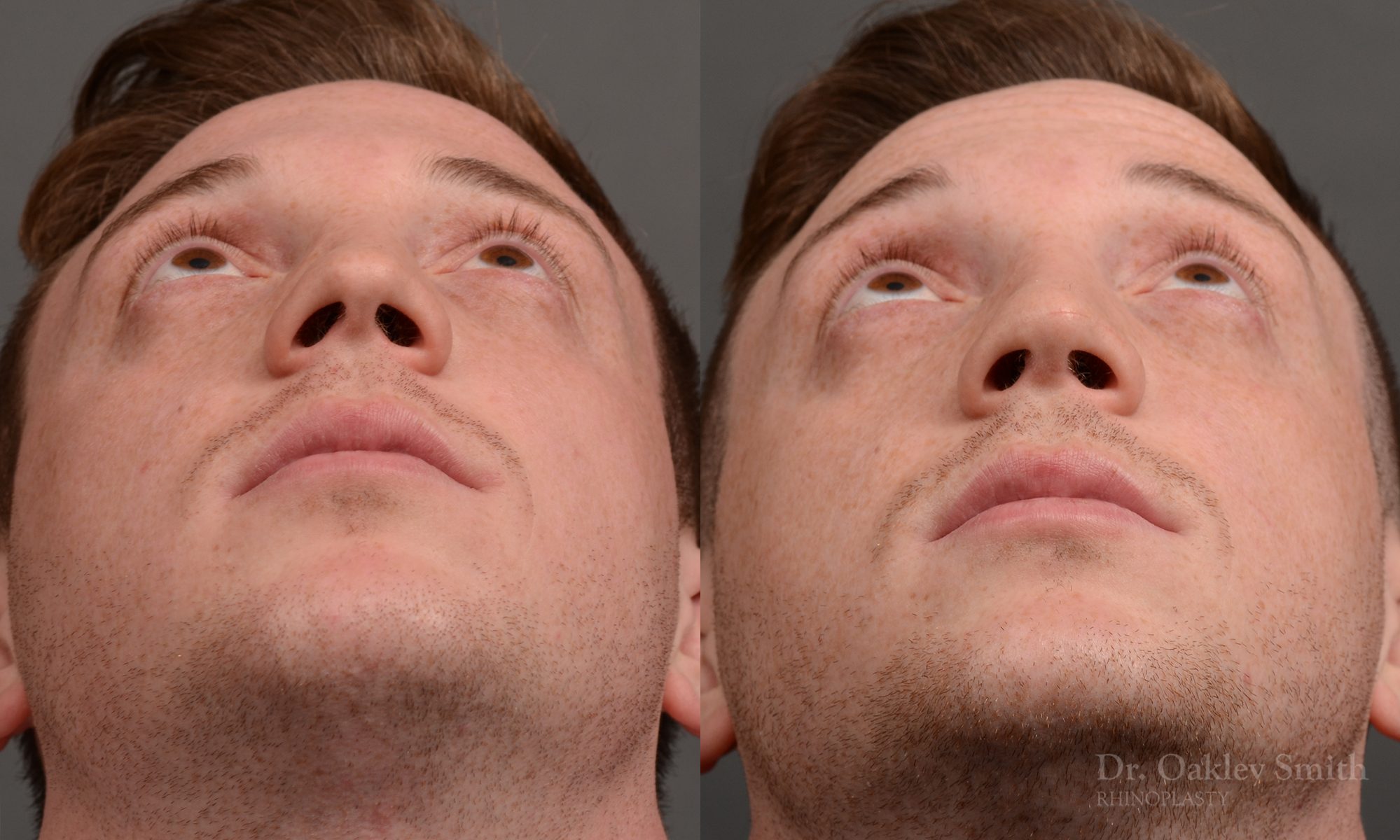 rhinoplasty Nothing demonstrates the skillful craftsmanship that Dr. Oakley Smith accomplishes during his surgeries than a collection of before and after case studies. As one of a hand full of surgeons in North America who limits his practice to only Rhinoplasty surgery, it is obvious that he has mastered his art. There is no question why he is one of the busiest cosmetic nose job surgeons in the country.