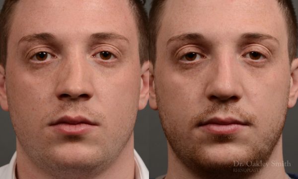 Male rhinoplasty to straigthen nose
