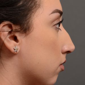 Hump reduction rhinoplasty on a beautiful young women