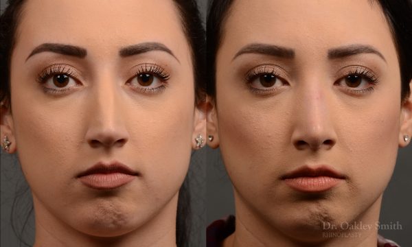 rhinoplasty Nothing demonstrates the skillful craftsmanship that Dr. Oakley Smith accomplishes during his surgeries than a collection of before and after case studies. As one of a hand full of surgeons in North America who limits his practice to only Rhinoplasty surgery, it is obvious that he has mastered his art. There is no question why he is one of the busiest cosmetic nose job surgeons in the country.